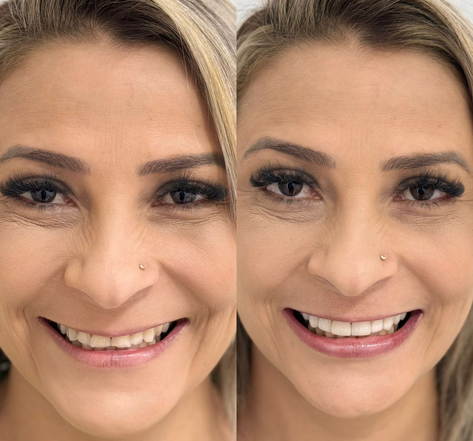 Antes e depois de tratamento odontológico na Sorridents Goiânia Campinas