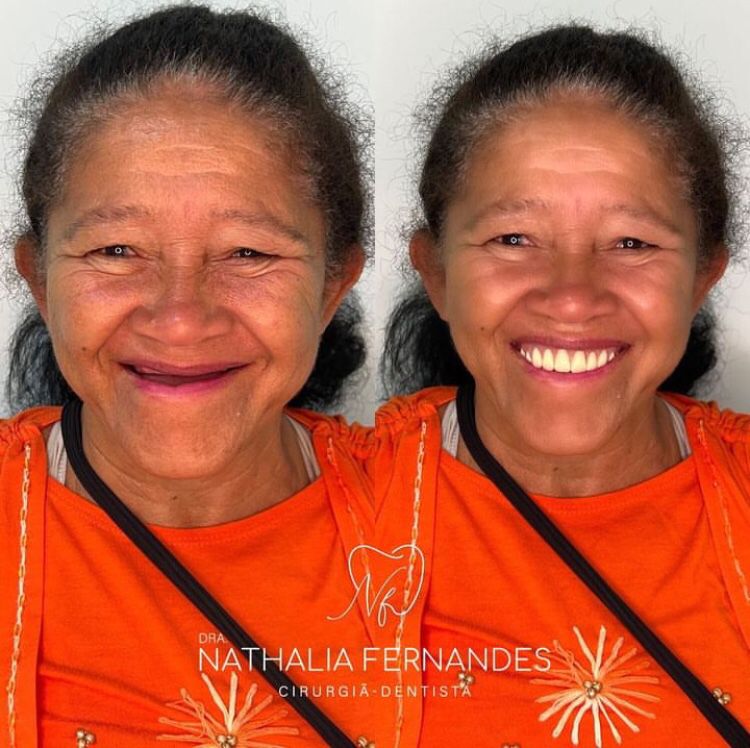 Antes e depois de prótese total superior