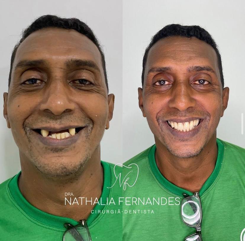 Antes e depois de prótese total superior