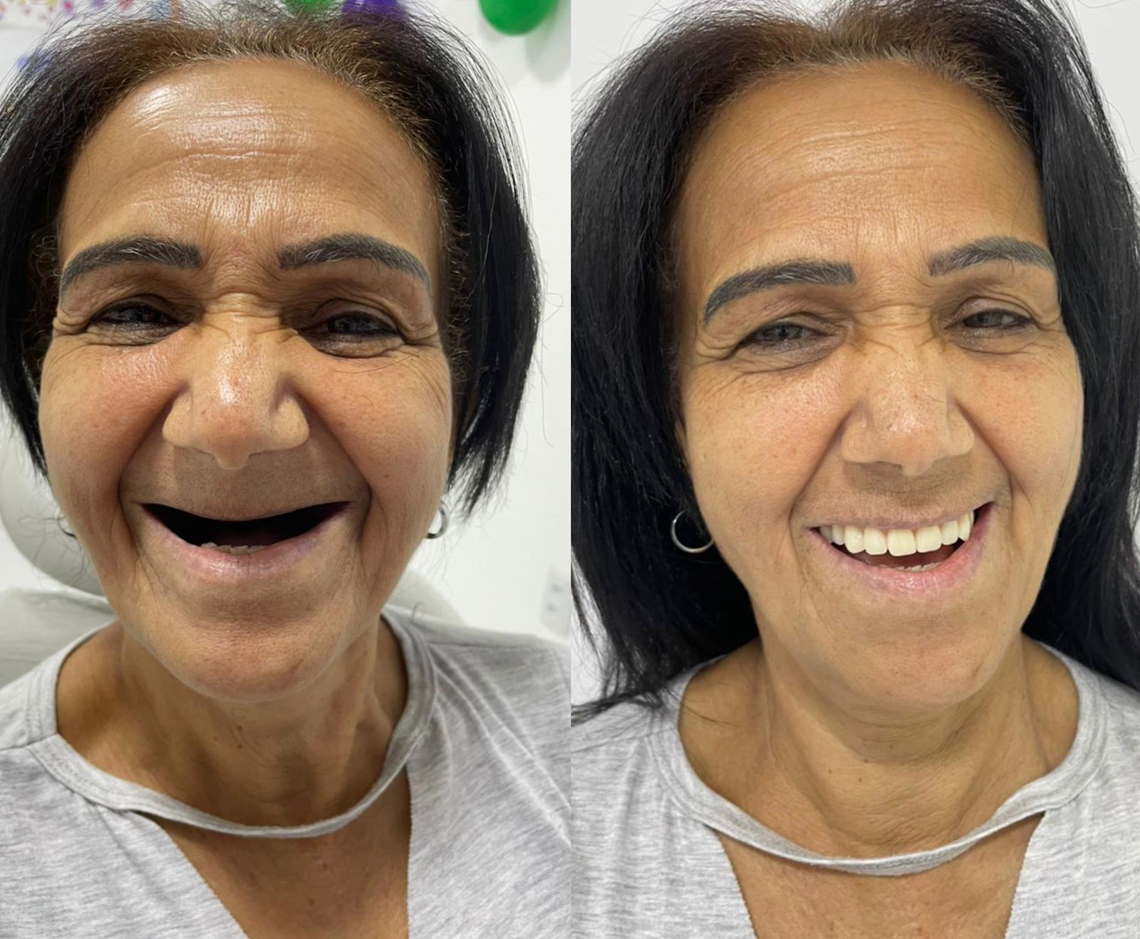 Antes e depois de protocolo superior