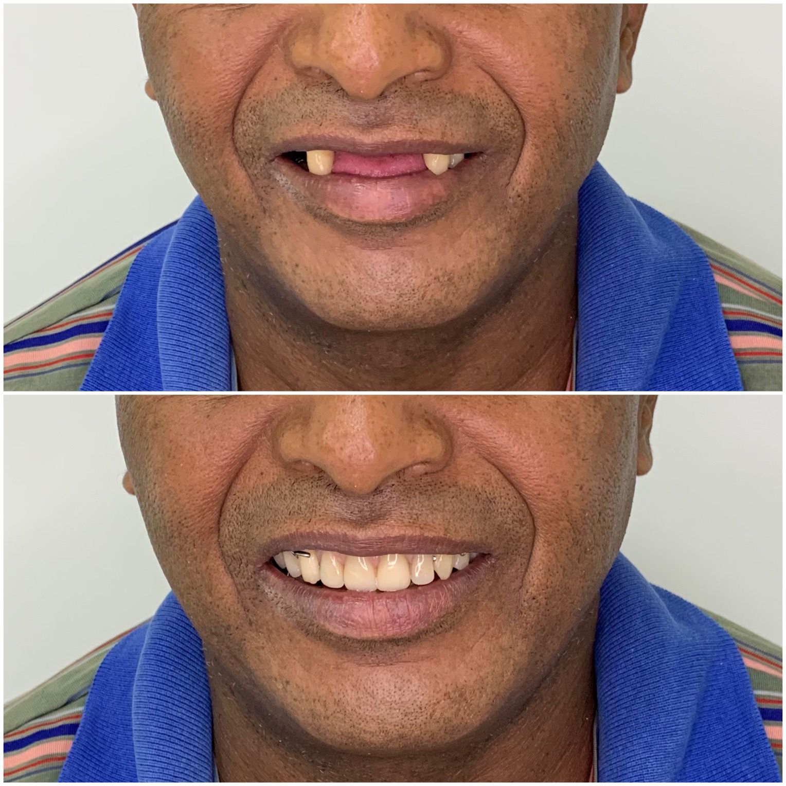 Antes e depois de prótese parcial removível superior