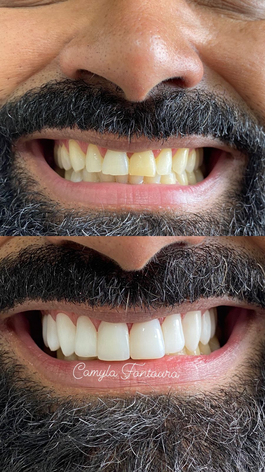 Antes e depois de reabilitação oral na Sorridents Goiânia Campinas